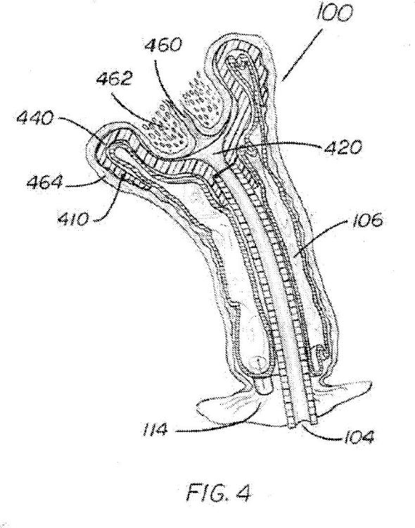 Ilustración 4 de la Galería de ilustraciones de Dispositivo de estabilización de cuello uterino