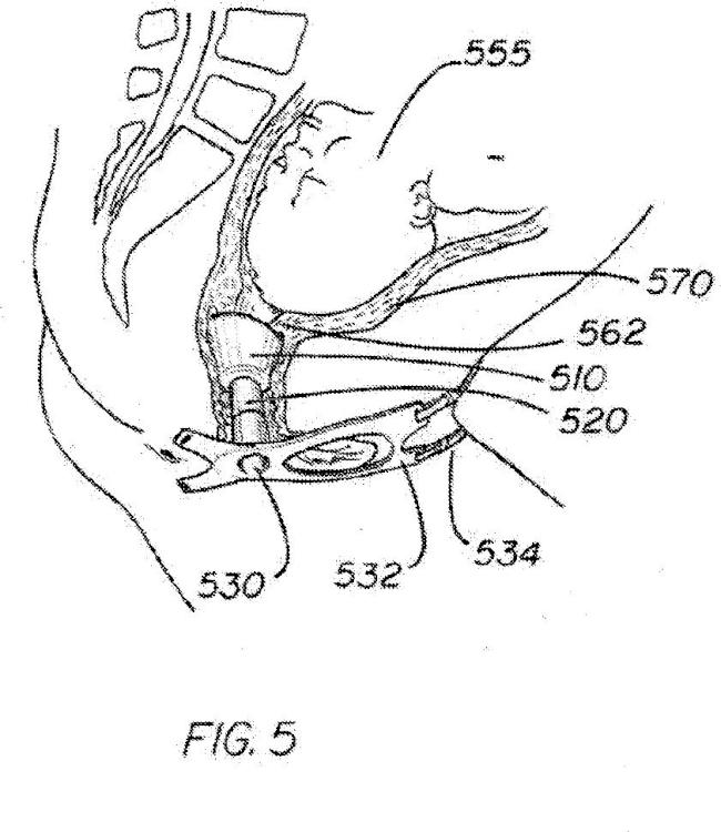Ilustración 5 de la Galería de ilustraciones de Dispositivo de estabilización de cuello uterino