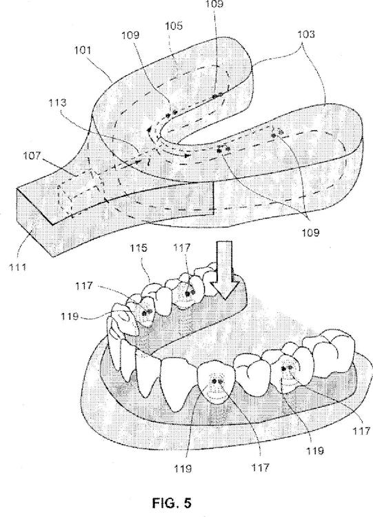 Ilustración 4 de la Galería de ilustraciones de Sistemas de retención dental
