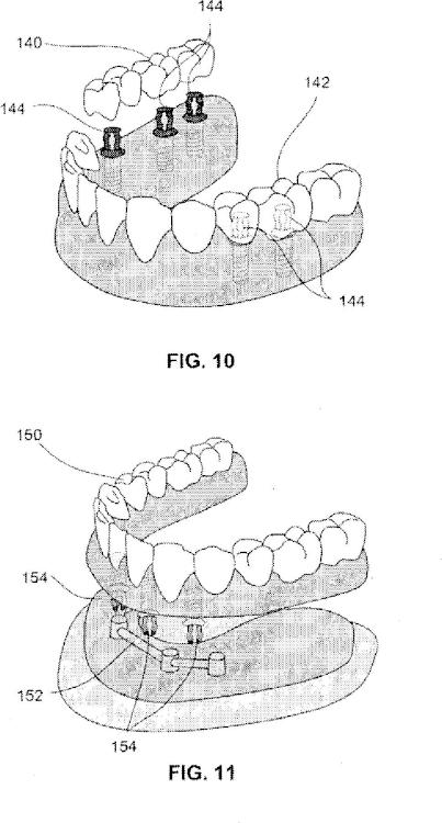 Ilustración 10 de la Galería de ilustraciones de Sistemas de retención dental