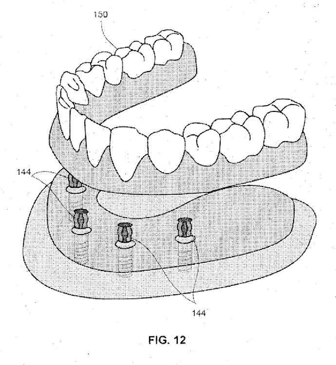 Ilustración 11 de la Galería de ilustraciones de Sistemas de retención dental