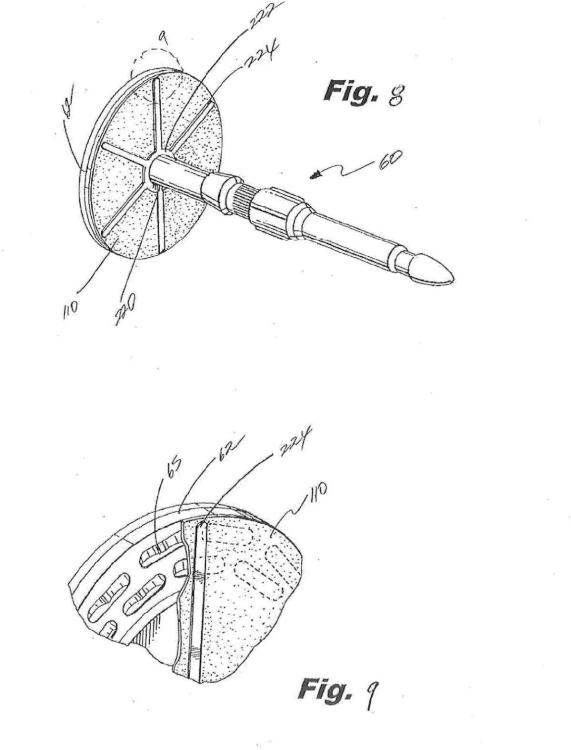 Ilustración 5 de la Galería de ilustraciones de Diseño de soporte de contrafuerte para un yunque de una grapadora quirúrgica