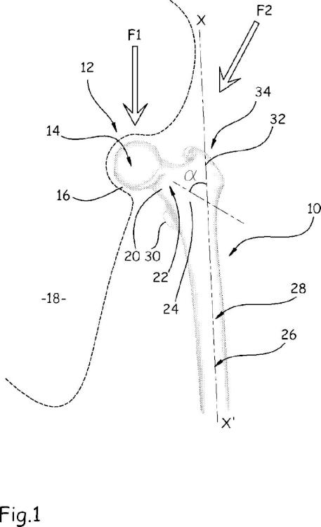 Ilustración 1 de la Galería de ilustraciones de Dispositivo implantable para el tratamiento preventivo o curativo de fracturas del fémur, ancilar asociado