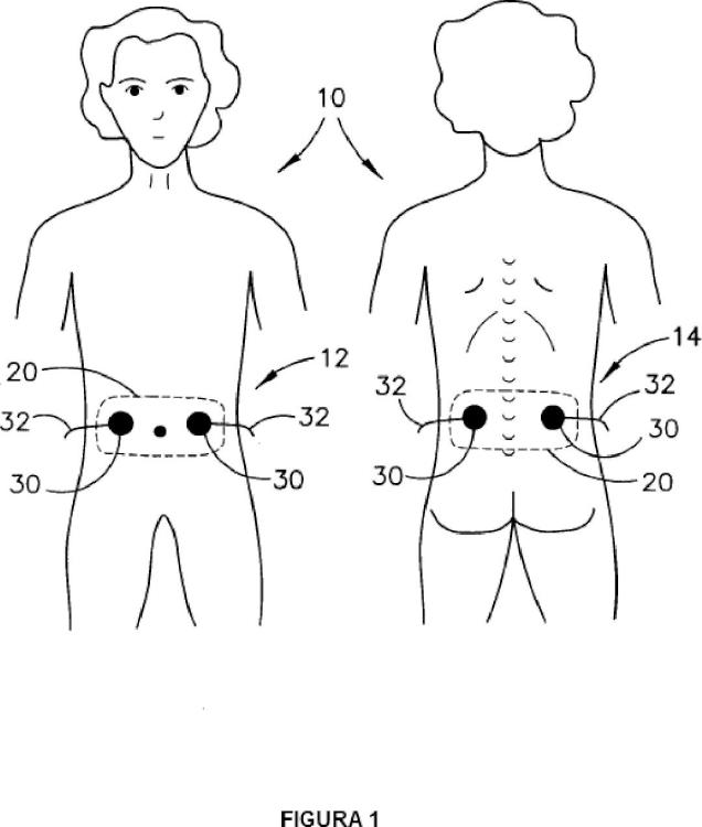 Ilustración 1 de la Galería de ilustraciones de Sistema de estimulación transcutánea