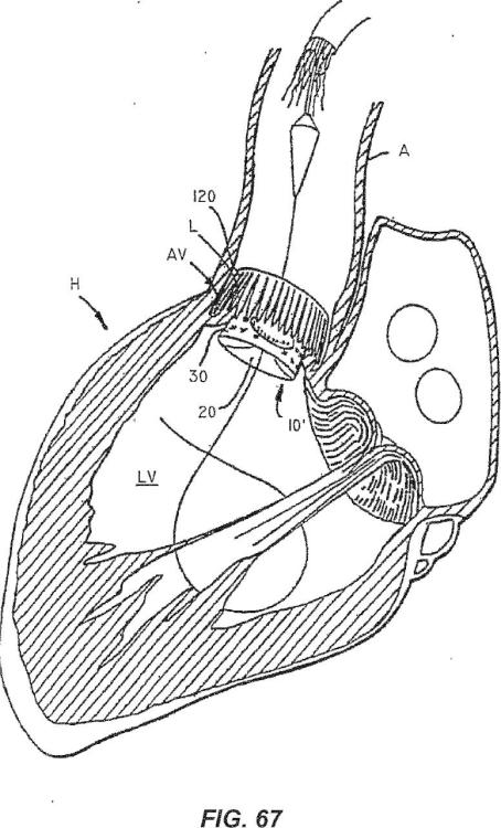 Ilustración 3 de la Galería de ilustraciones de Válvula cardíaca reposicionable