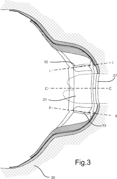 Ilustración 3 de la Galería de ilustraciones de Control de la flexión de una placa para la piel para usar en un aparato de ostomía