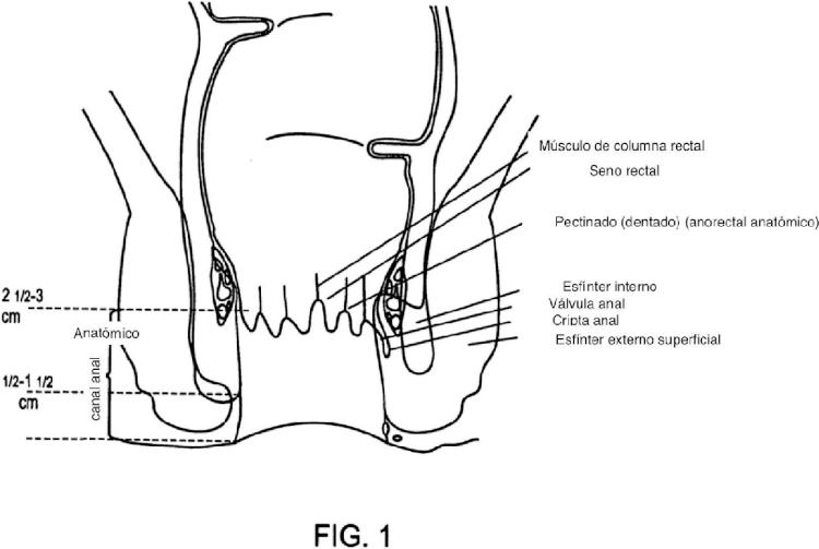 Ilustración 1 de la Galería de ilustraciones de Dispositivo y sistema para incontinencia fecal