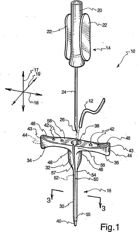 Ilustración 1 de la Galería de ilustraciones de Proceso de moldeo por inyección en un único paso para fabricar una vaina de catéter