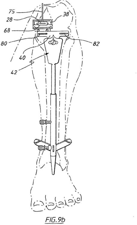 Ilustración 7 de la Galería de ilustraciones de Aparato para uso en artroplastia en una articulación de rodilla