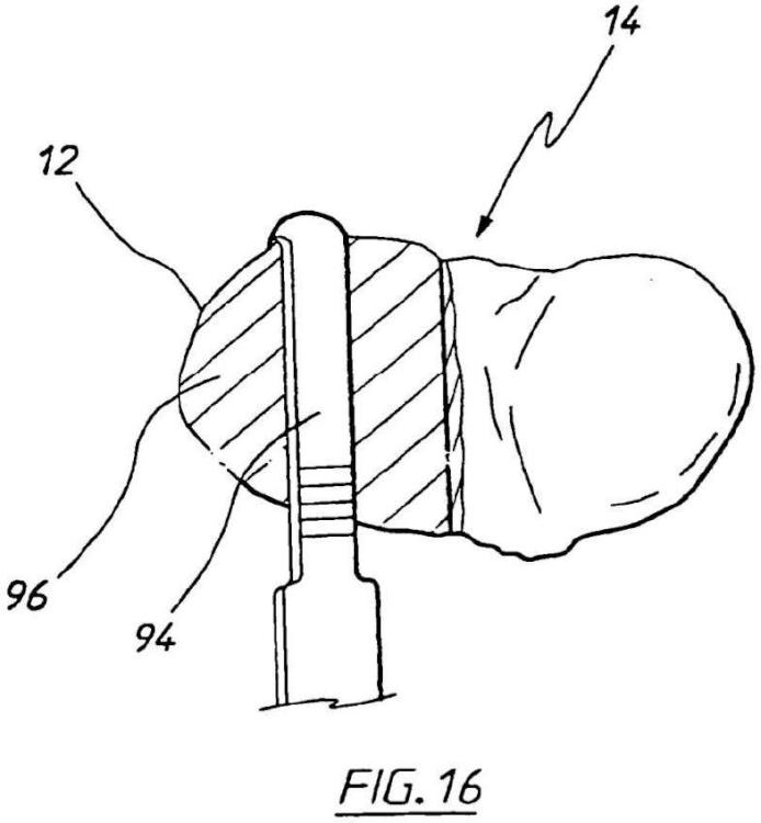 Ilustración 11 de la Galería de ilustraciones de Aparato para uso en artroplastia en una articulación de rodilla