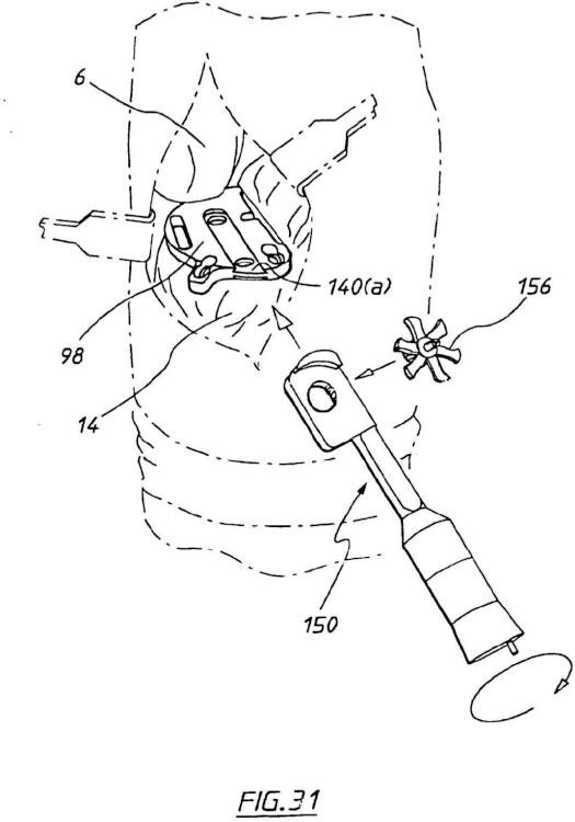 Ilustración 19 de la Galería de ilustraciones de Aparato para uso en artroplastia en una articulación de rodilla