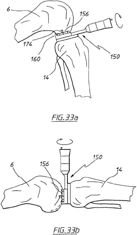 Ilustración 21 de la Galería de ilustraciones de Aparato para uso en artroplastia en una articulación de rodilla