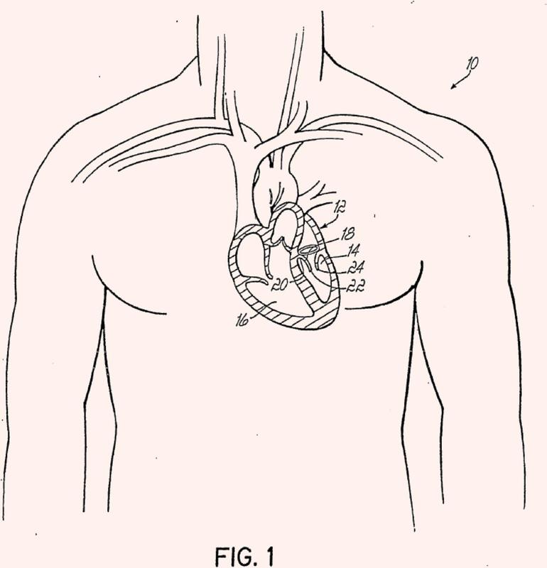 Dispositivo y método para mejorar la función de una válvula del corazón.