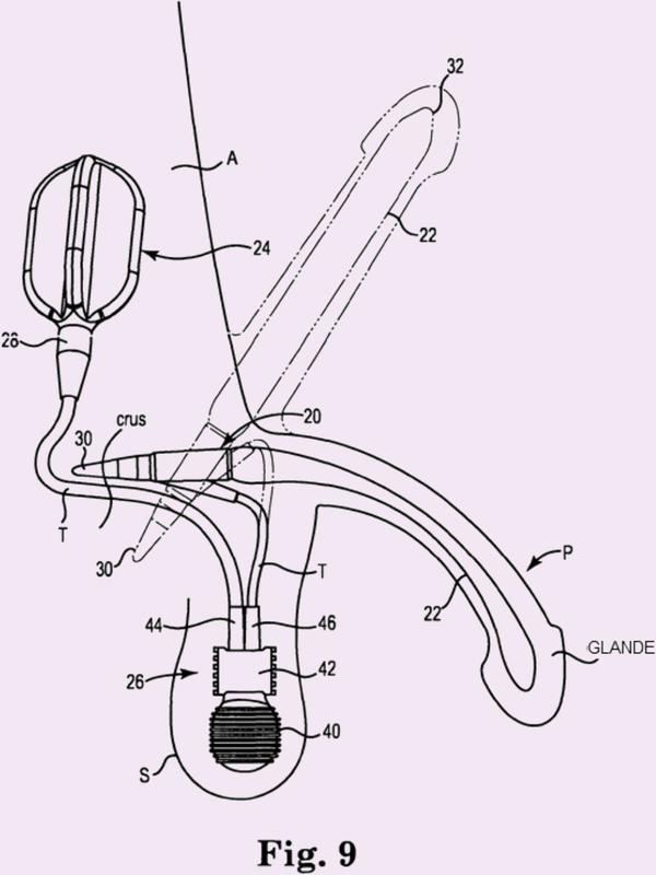 Conjunto válvula de cierre de prótesis de pene implantable.
