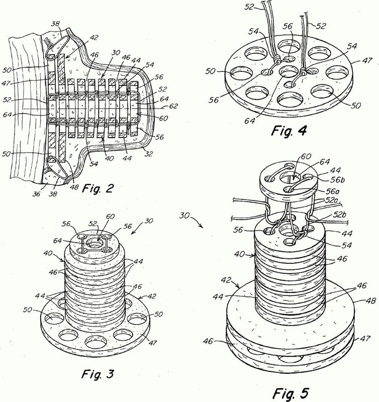 Ilustración 1 de la Galería de ilustraciones de Prótesis implantable para reconstrucción de una característica anatómica