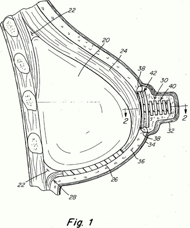 Ilustración 4 de la Galería de ilustraciones de Prótesis implantable para reconstrucción de una característica anatómica