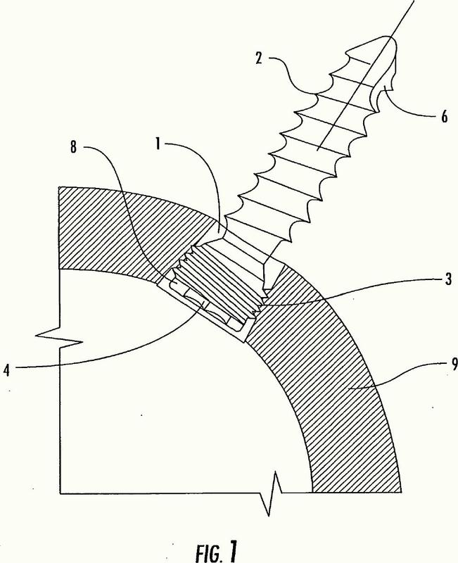 Tornillos de fijación acetabular de bloqueo y su combinación con una copa acetabular para cadera invertida.