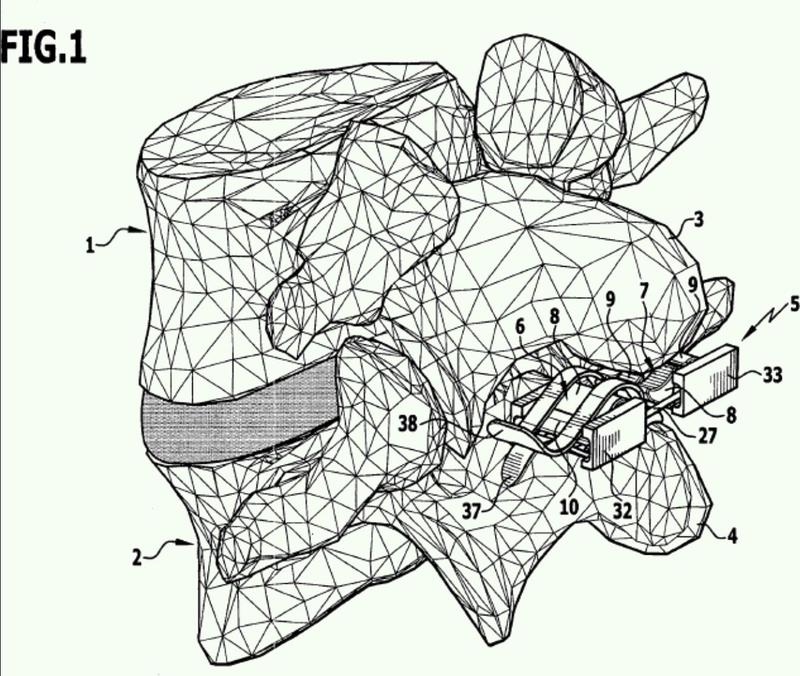 Ilustración 4 de la Galería de ilustraciones de Implante para el apoyo mutuo de las apófisis espinosas de cuerpos vertebrales