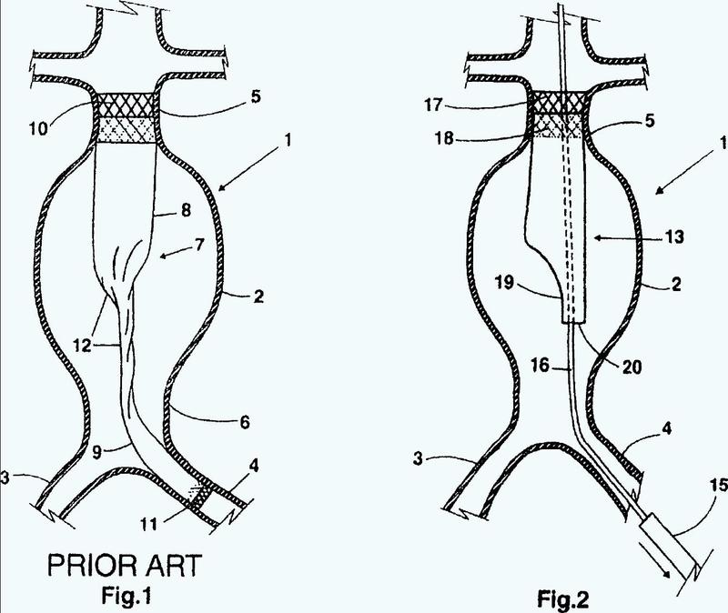 Prótesis aórtica para el tratamiento de aneurismas aórticos abdominales y uso de la prótesis.