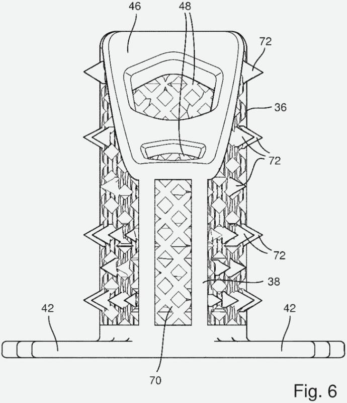 Implante de tibia para tensar los ligamentos de rótula.