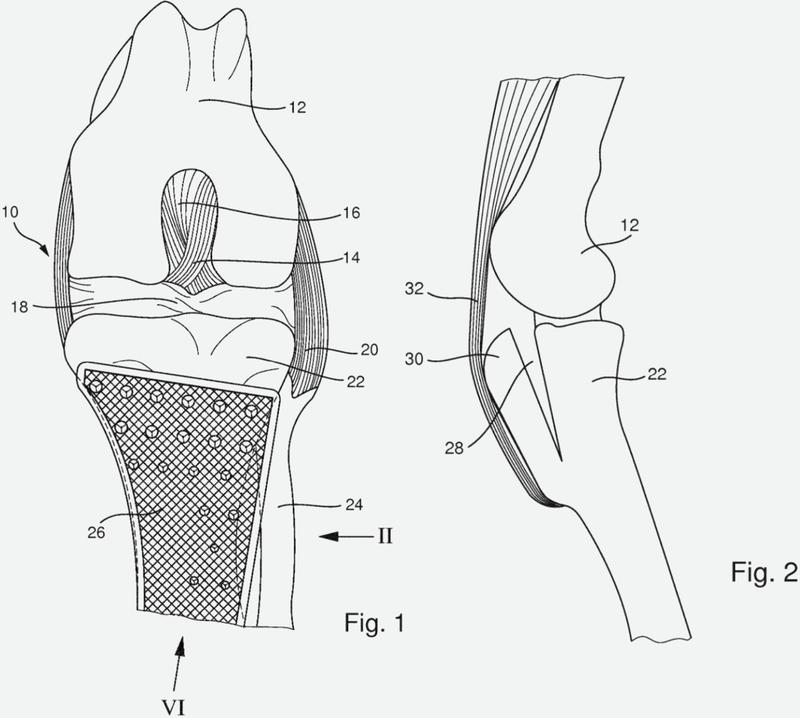 Implante de tibia para tensar los ligamentos de rótula.