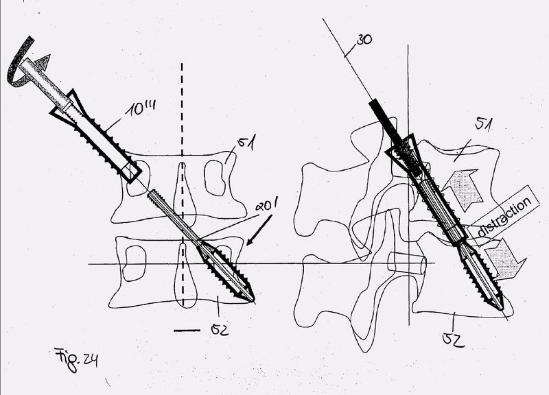 Ilustración 2 de la Galería de ilustraciones de Dispositivo para estabilizar una columna vertebral