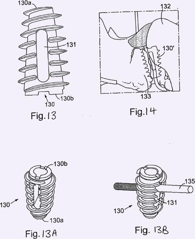 Implantes espinales y fijación espinal.