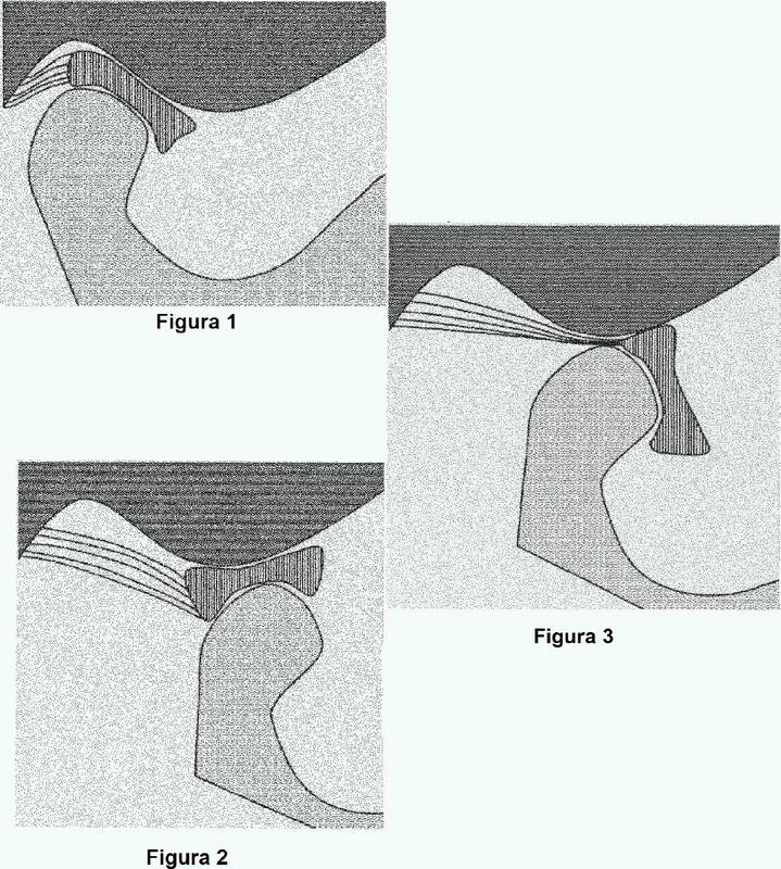 Método para determinar el impacto de una modificación dental propuesta sobre la articulación temporomandibular.