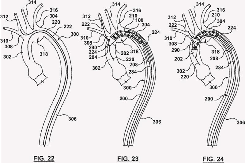 Ilustración 3 de la Galería de ilustraciones de El acoplamiento externo móvil para conexión de rama vascular