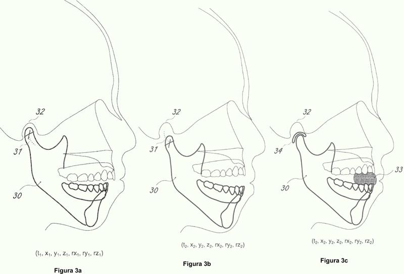 Procedimiento para la creación de una imagen virtual de la mandíbula.