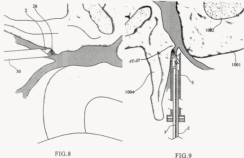 Dispositivo y procedimiento para la intervención mínimamente invasiva en la columna vertebral.