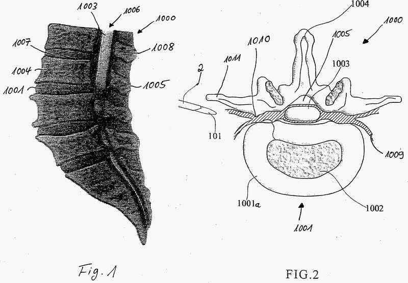 Dispositivo y procedimiento para la intervención mínimamente invasiva en la columna vertebral.