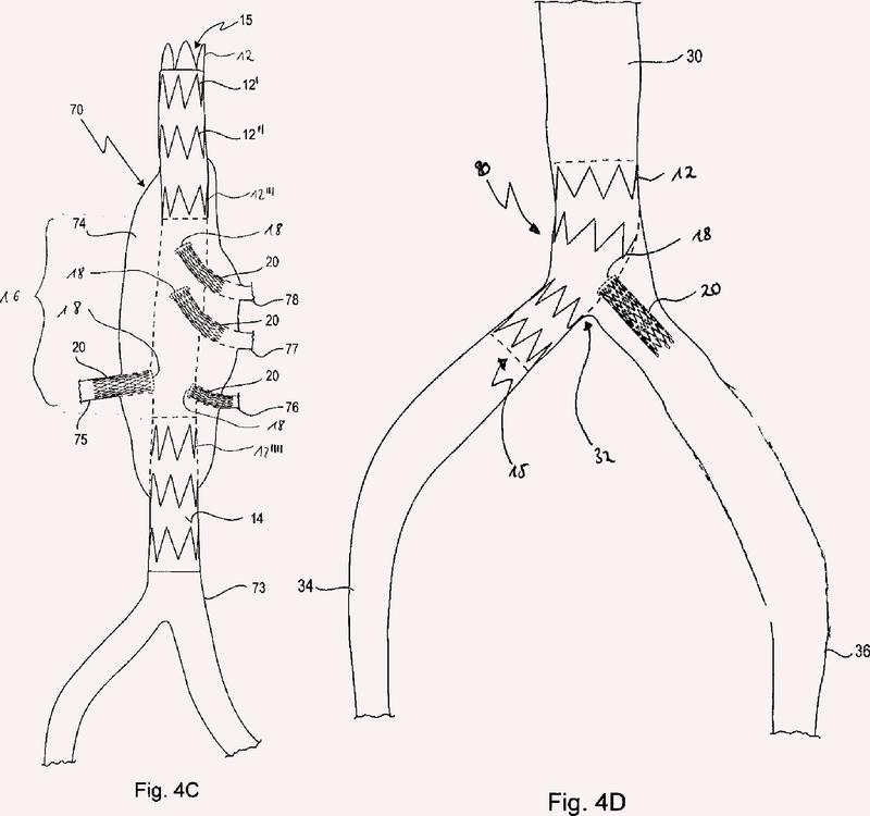 Ilustración 3 de la Galería de ilustraciones de Prótesis vascular intraluminal con fenestración in situ