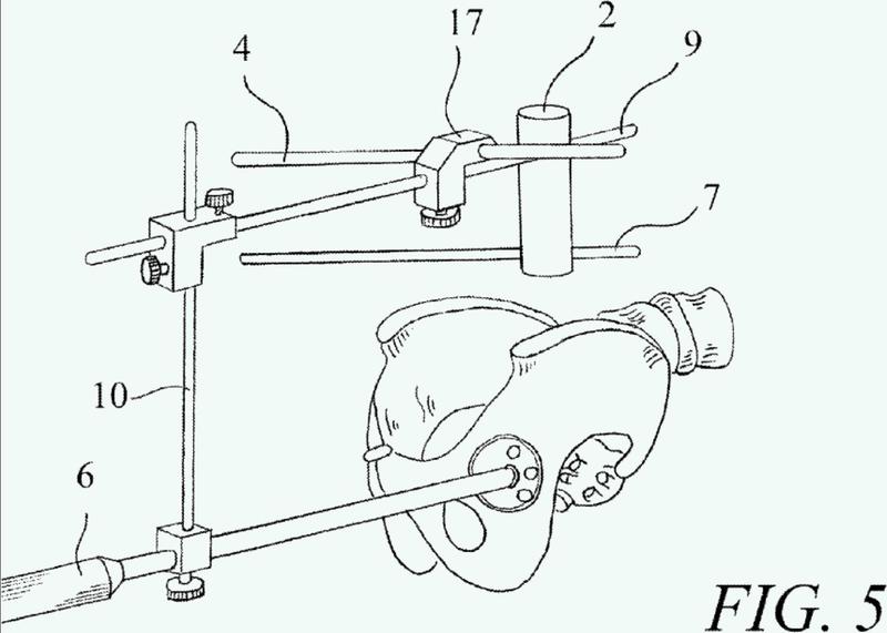 Ilustración 3 de la Galería de ilustraciones de Dispositivo para el posicionamiento de la copa acetabular y método para ello