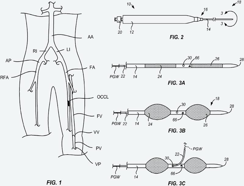 Sistema para sortear oclusiones en una arteria femoral.