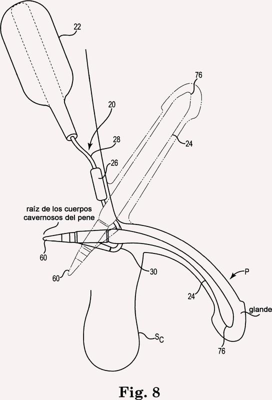 Ilustración 3 de la Galería de ilustraciones de Prótesis de pene inflable de manera peristáltica