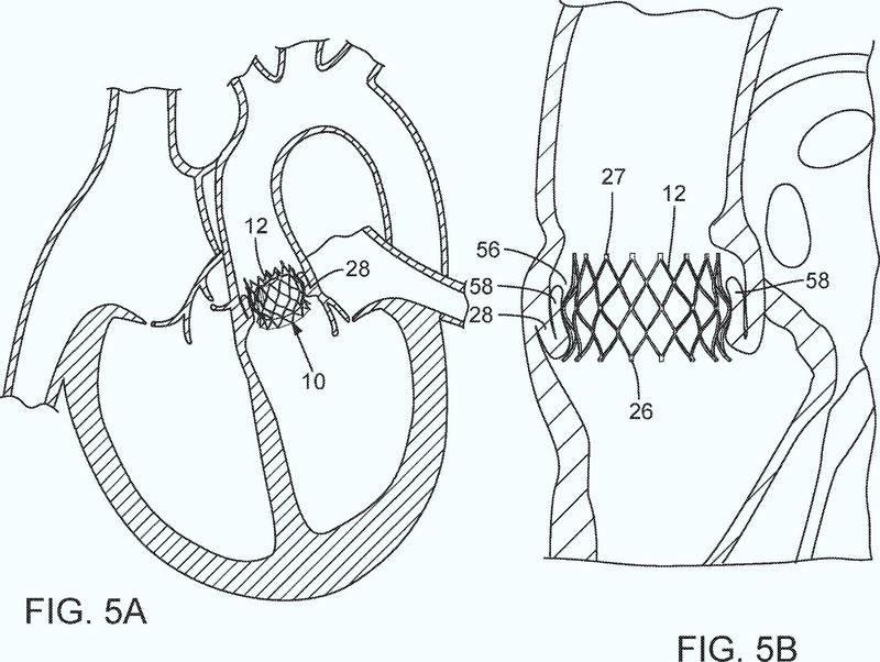 Ilustración 1 de la Galería de ilustraciones de Aparato de suministro de válvula cardiaca protésica que presenta un mecanismo de embrague