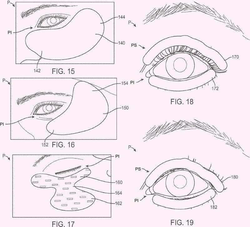 Ilustración 3 de la Galería de ilustraciones de Sistemas de tratamiento de ojo seco