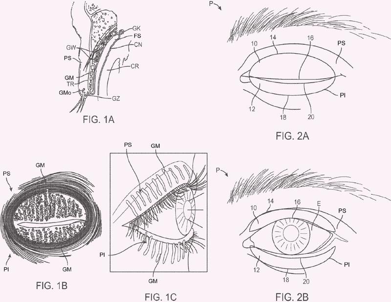 Ilustración 4 de la Galería de ilustraciones de Sistemas de tratamiento de ojo seco