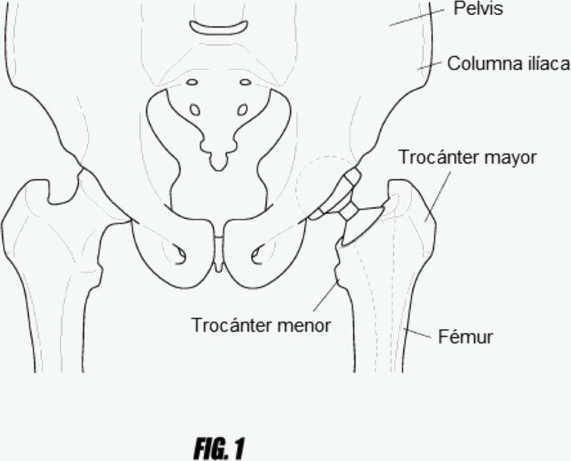 Ilustración 4 de la Galería de ilustraciones de Sistemas de cirugía de la cadera