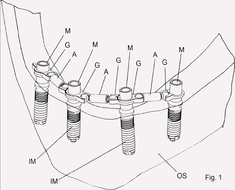 Ilustración 4 de la Galería de ilustraciones de Aparato modular para la instalación de prótesis dentales múltiples