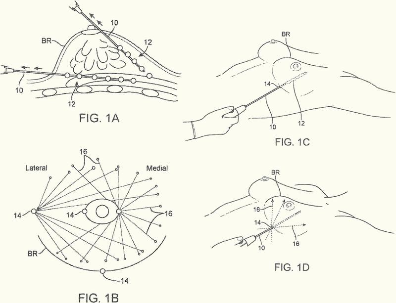 Ilustración 4 de la Galería de ilustraciones de Sistemas de transferencia de tejidos