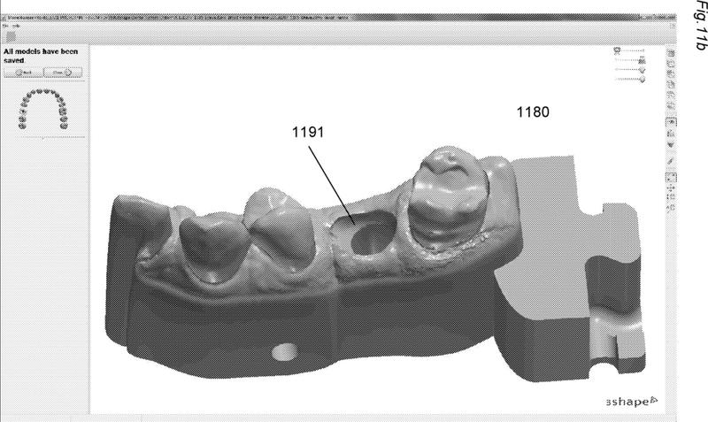 Ilustración 3 de la Galería de ilustraciones de Método de modificación de la parte gingival de un modelo virtual de una dentadura