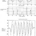 Ilustración 5 de CONTROL DE TRACCIÓN Y DESVIACIÓN LATERAL CON ESTABILIDAD MEJORADA, UTILIZANDO UN DIFERENCIAL CONTROLADO ELETRÓNICAMENTE CON DESLIZAMIENTO LIMITADO