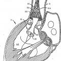Ilustración 1 de Válvula cardiaca sustituible