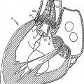 Ilustración 2 de Válvula cardiaca sustituible