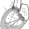 Ilustración 5 de Válvula cardiaca sustituible