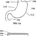 Ilustración 1 de Dispositivos para el tratamiento de la obesidad y de la enfermedad de reflujo gastroesofágico (ERGE) mediante la intususcepción de una parte de tejido del estómago