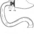 Ilustración 12 de Prótesis gastrointestinales modulares