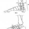 Ilustración 4 de Sistema de compresión y fijación de pie, tobillo y extremidad inferior.